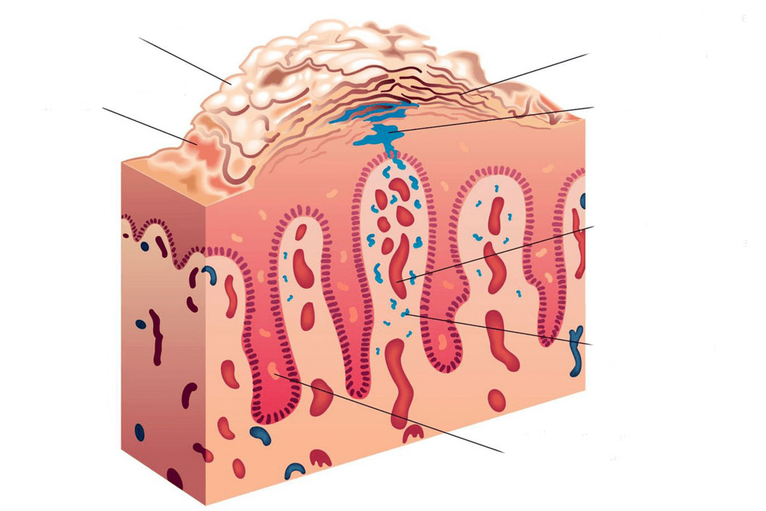 sección transversal da pel na psoríase