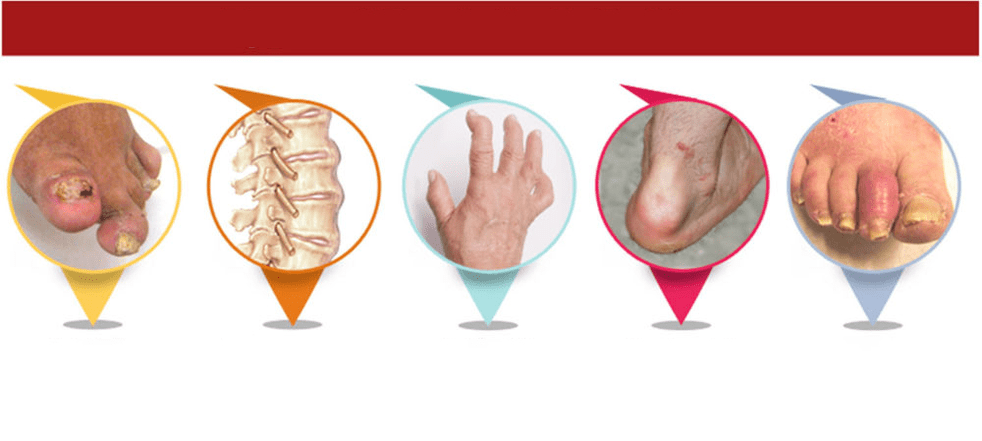 tipos de artrite psoriásica