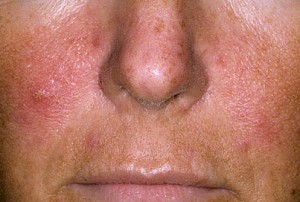 os síntomas da psoriase na cara