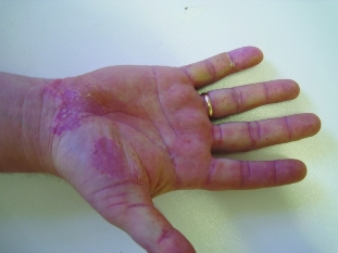 Pústulas das palmas das mans e plantas